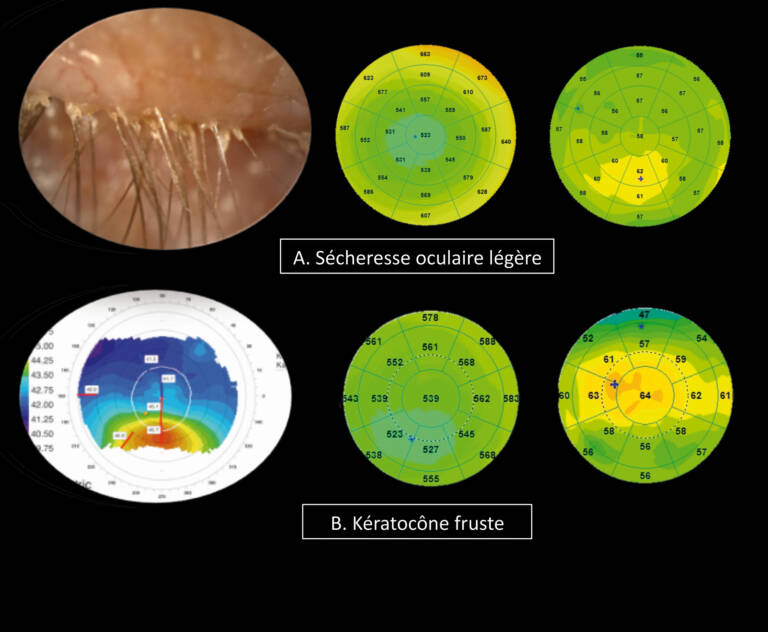 Figure 5. &nbsp;Comparison between two stages of localized epithelial hyperplasia in dry eye syndrome in the same patient described in the case study, and in a patient with forme fruste keratoconus. Variability of distribution of epithelial pachymetry is much greater in dry eye syndrome, whereas that of total pachymetry is greater in subclinical keratoconus.
