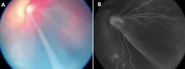 Figure 1. Rétinophotographie (A) et angiographie à la fluorescéine (B) montrant un décollement de rétine dans le cadre d’une persistance de la vascularisation fœtale.
