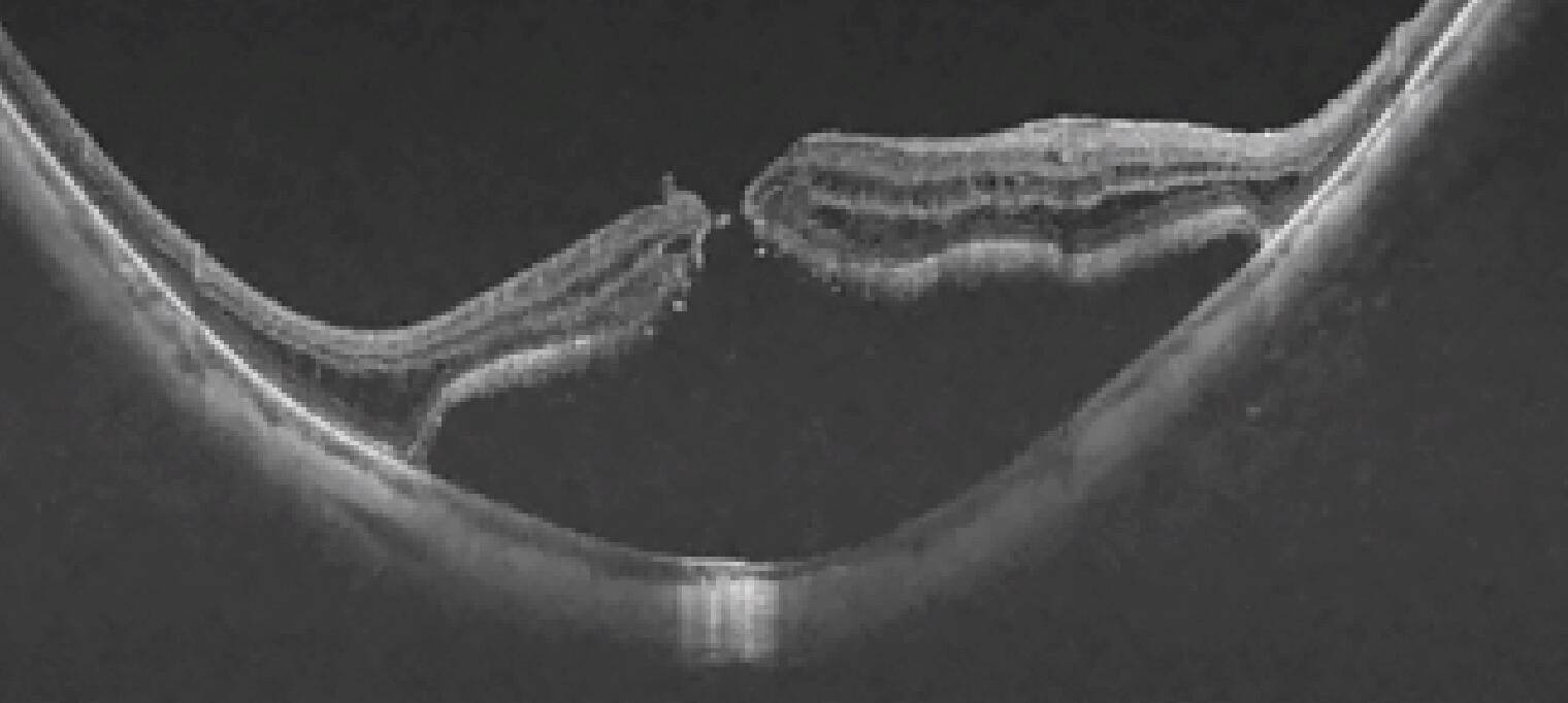 Figure 2. OCT en coupe maculaire d’un œil myope fort : décollement de rétine associé à un trou maculaire sur fond de staphylome postérieur. L’espace sous-rétinien est bien visible, avec un soulèvement du neuroépithélium au pôle postérieur.
