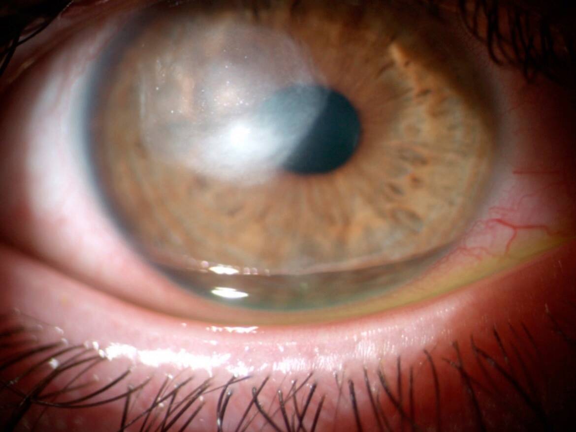 Figure 1. Taie cornéenne séquellaire d’une kératite microbienne sévère chez un adolescent de 12 ans, suite à un mésusage de lentilles à renouvellement fréquent (baignade) (source : Dr Madariaga).

