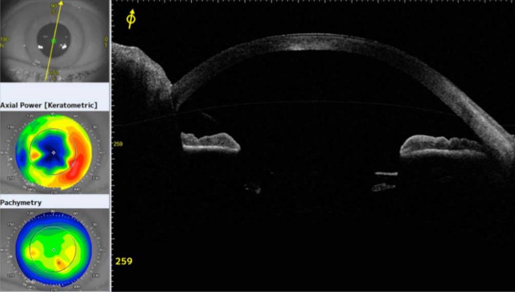 Figure 3. Coupe en OCT swept-source : aspect anormalement plat du dôme cornéen.
