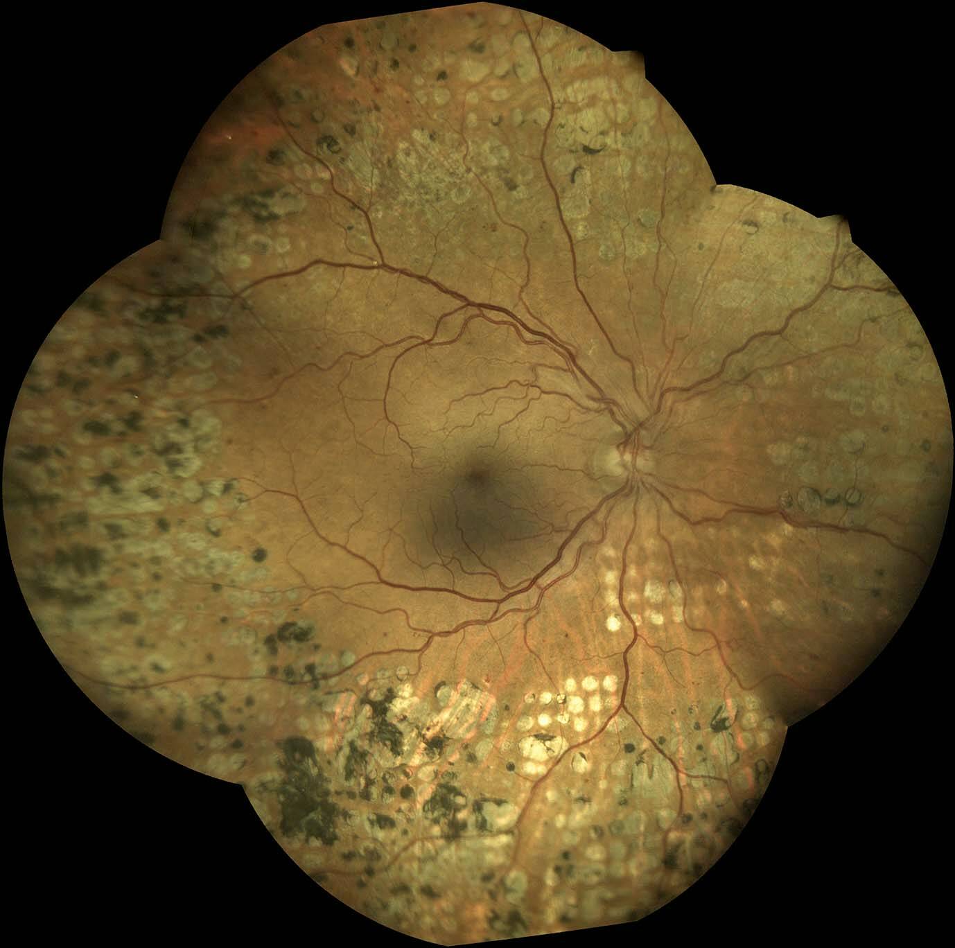 Figure 5. Rétinopathie diabétique traitée par photocoagulation panrétinienne (PPR). Montage de 5 clichés Eidon à 90 °.
