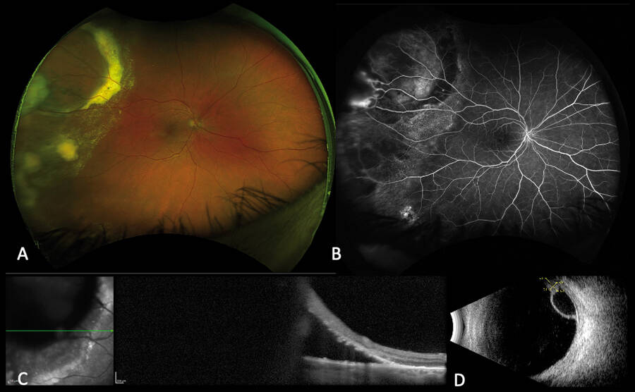 Figure 7. A. Photo grand champ du fond d’œil montrant un aspect de décollement séreux rétinien supérotemporal associé à des exsudats secs. B. Angiographie à la fluorescéine montrant des télangiectasies vasculaires périphériques. C. Coupe OCT passant par la lésion bulleuse montrant un décollement séreux rétinien. E. Échographie en mode B montrant une lésion gliale isoéchogène associée à un décollement séreux rétinien. 
