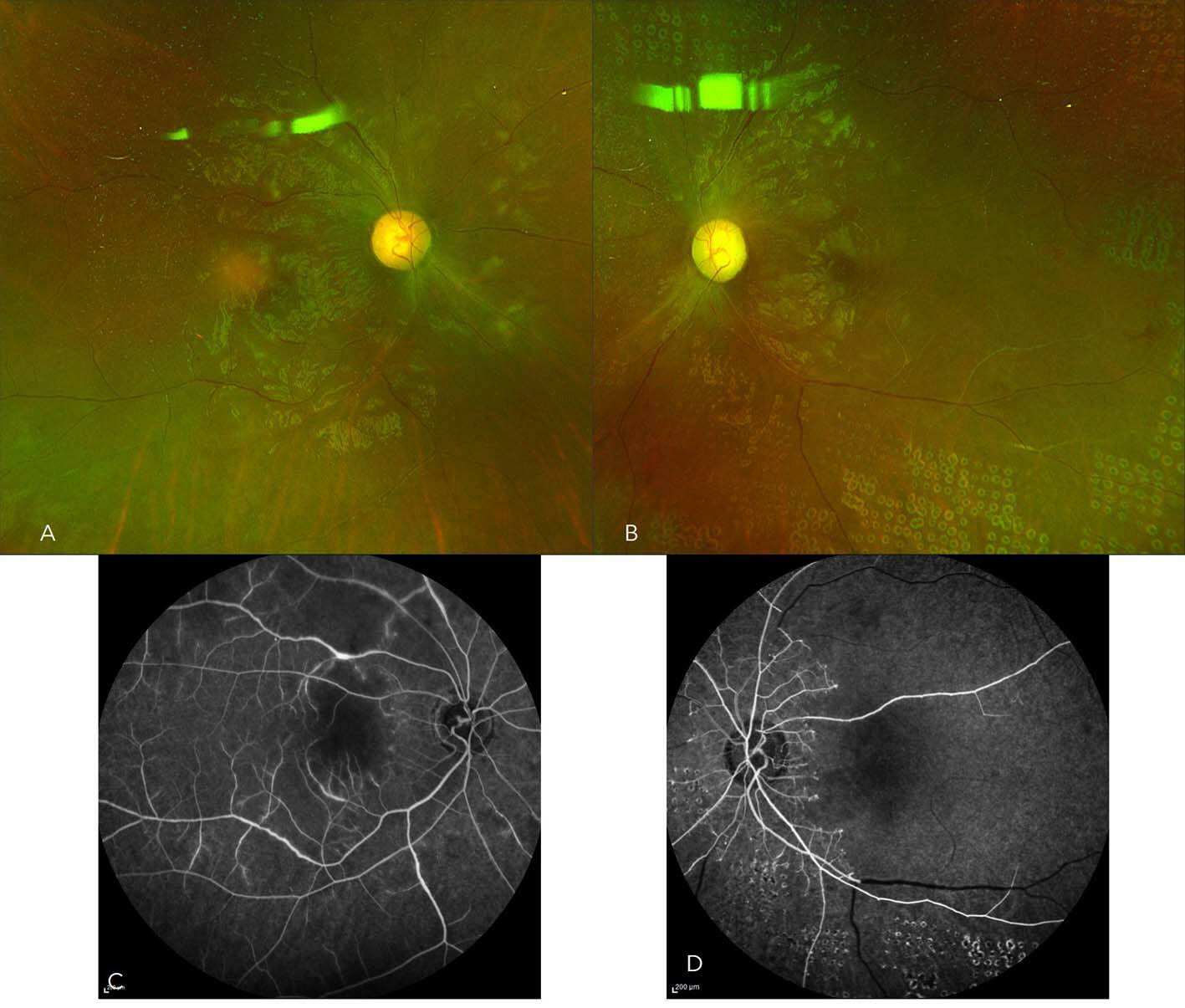 Figure 4. Rétinopathie lupique très sévère associée à une néphropathie lupique. A et B. La rétinophotographie montre des vaisseaux fantômes totalement occlus, avec de nombreux nodules cotonneux. C et D. L’angiographie à la fluorescéine révèle l’atteinte dramatique artérielle avec une ischémie majeure bilatérale et des diffusions artériolaires.
