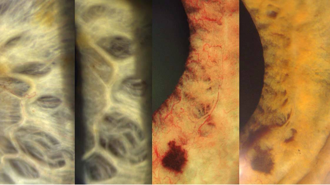 Figure 4. Photographie de SA de 2 patients : RI avant et après la prise en charge par IVT d’anti-VEGF et PPR chirurgicale jusqu’à l’ora.
