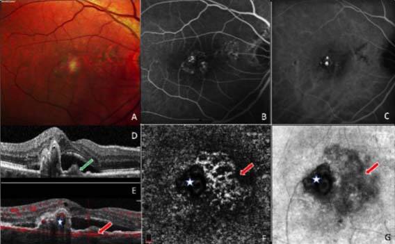 Figure 4. DEP d’une vasculopathie polypoïdale choroïdienne. A. Cliché couleur. B. L’AF montre une diffusion hétérogène modérée. C. L’ICG montre les 2 polypes hypercyanescents à la terminaison de vaisseaux choroïdiens anormaux. D et E. L’OCT montre les polypes (étoile) et le branching network (flèches) soulevant l’EP. F. L’OCT-A montre l’hypersignal de flux correspondant aux vaisseaux choroïdiens dilatés (flèche). Le polype n’est pas parfaitement visible (étoile). G. L’OCT en face montre les polypes (étoile).
