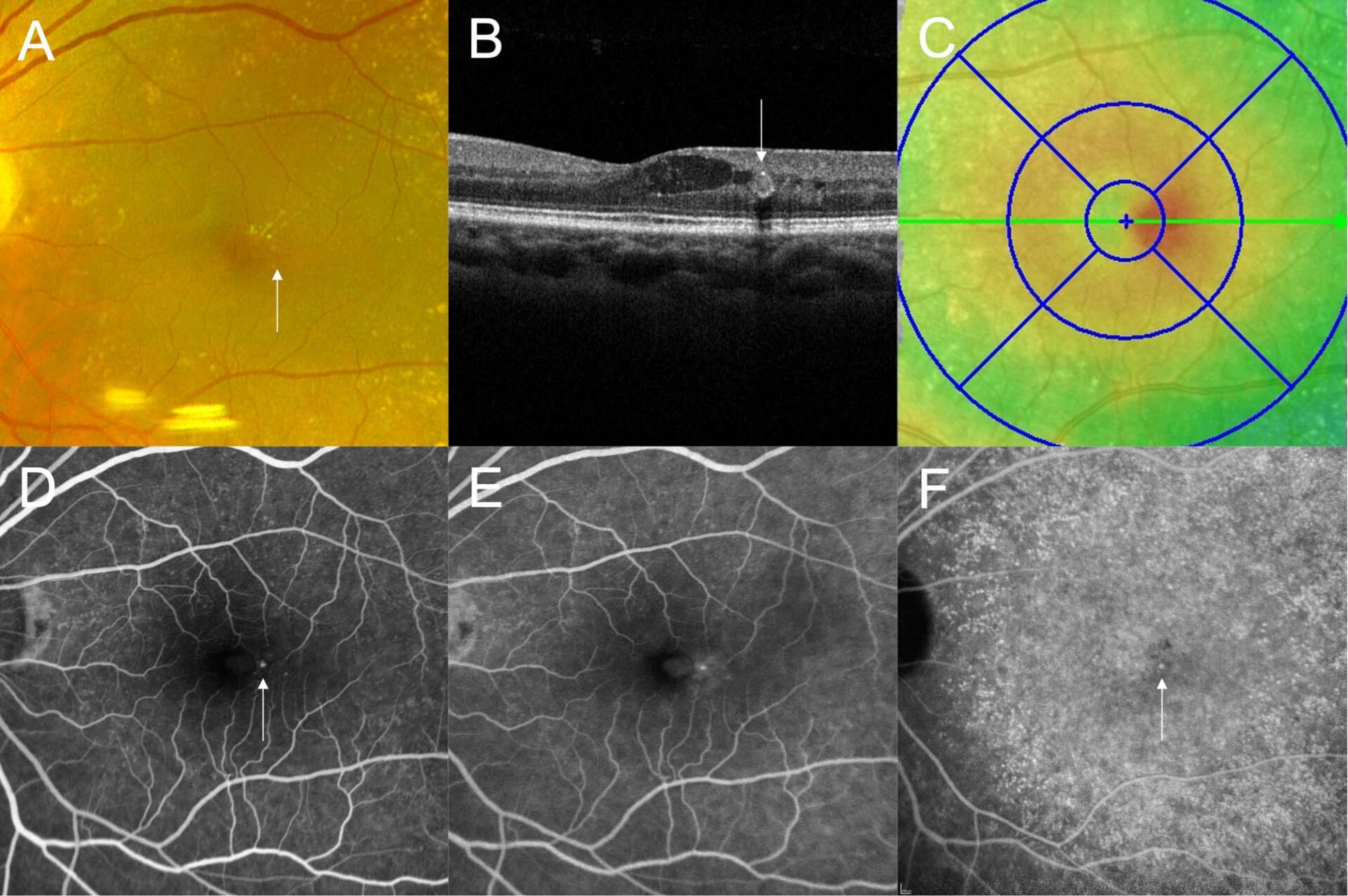 Figure 1. Clichés couleur, OCT, FA et ICG d’un cas de PEVAC. A. Exsudats secs lipidiques et possibles petites anomalies vasculaires en temporal de la macula, visibles sur le cliché couleur (flèche). B. Coupe verticale de l’OCT passant par l’anomalie vasculaire. Celle-ci présente un aspect de macroanévrysme avec une paroi hyperréflective et masque les structures sous-jacentes. C. Mapping de l’OCT révélant l’épaississement focal de l’OMC associé au macroanévrysme. D et E. Temps précoces et tardifs de l’AF. Le macroanévrysme s’imprègne dès les temps précoces et diffuse aux temps tardifs. F. Le macroanévrysme est également bien visible sur ce cliché d’un temps intermédiaire de l’ICG.
