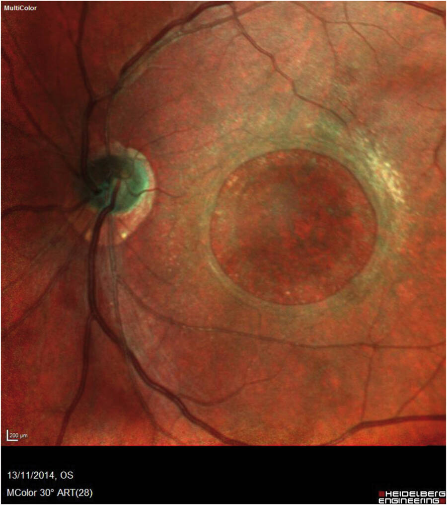 Figure 1. Trou maculaire géant, ancien, chez un patient porteur d’un syndrome d’Alport.
