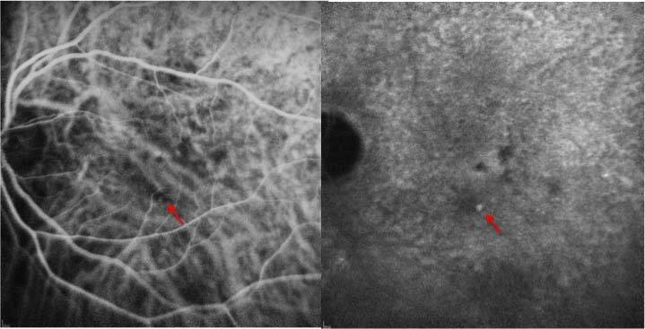 Figure 2. Aspect en angiographie en ICG d’une néovascularisation de type 3 au temps précoce (à gauche) et au temps tardif (à droite). On note la présence d’une hyperfluorescence précoce (flèche rouge) au voisinage d’un vaisseau rétinien avec hot spot au temps tardif.
