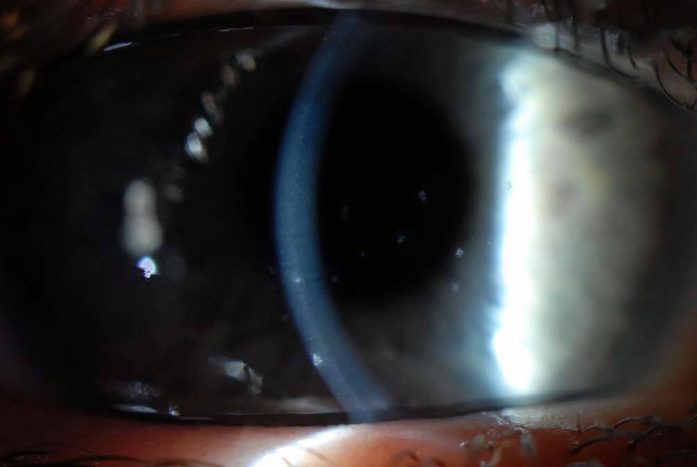 Figure 5. Kératite de Thygeson en lampe à fente (Eyewiki, courtesy of Dr Amir A. Azari, Wills Eye Hospital).
