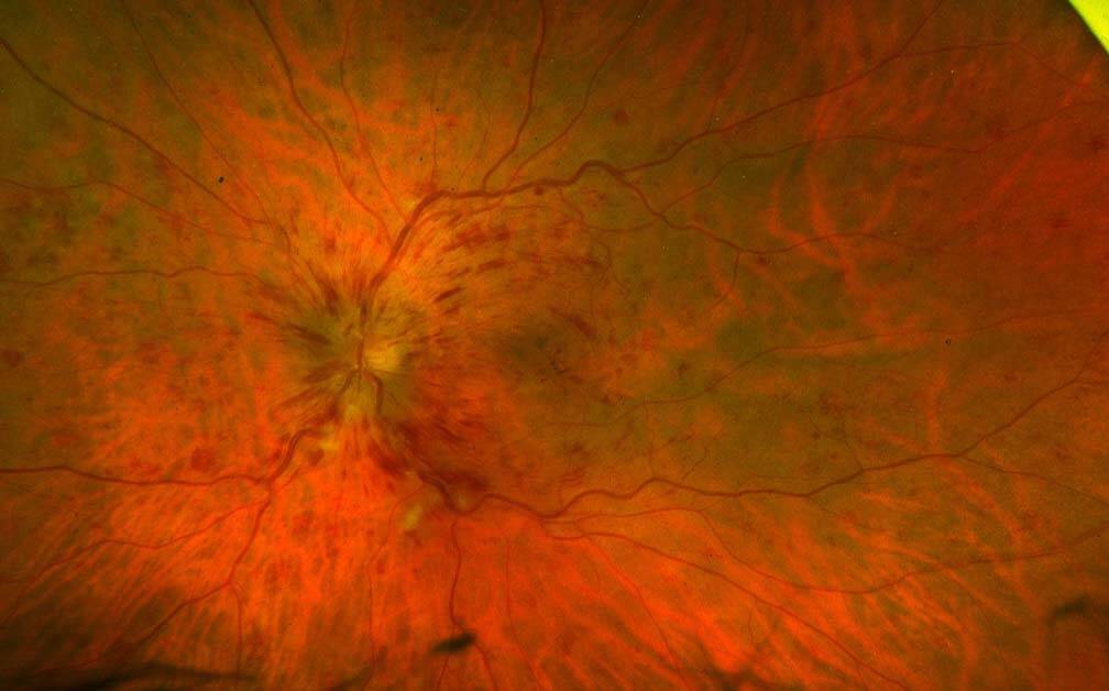 Figure 1a. OVCR chez un homme de 54 ans sans aucun facteur de risque vasculaire, ayant une récupération complète après 3 IVT d’induction qui lui ont permis de recouvrer totalement son acuité visuelle, initialement de 5/10 (patient « happy few »).
