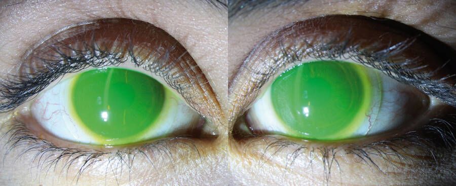 Figure 5. Notre patiente équipée de lentilles sclérales AKS, avec un beau ménisque de larmes.
