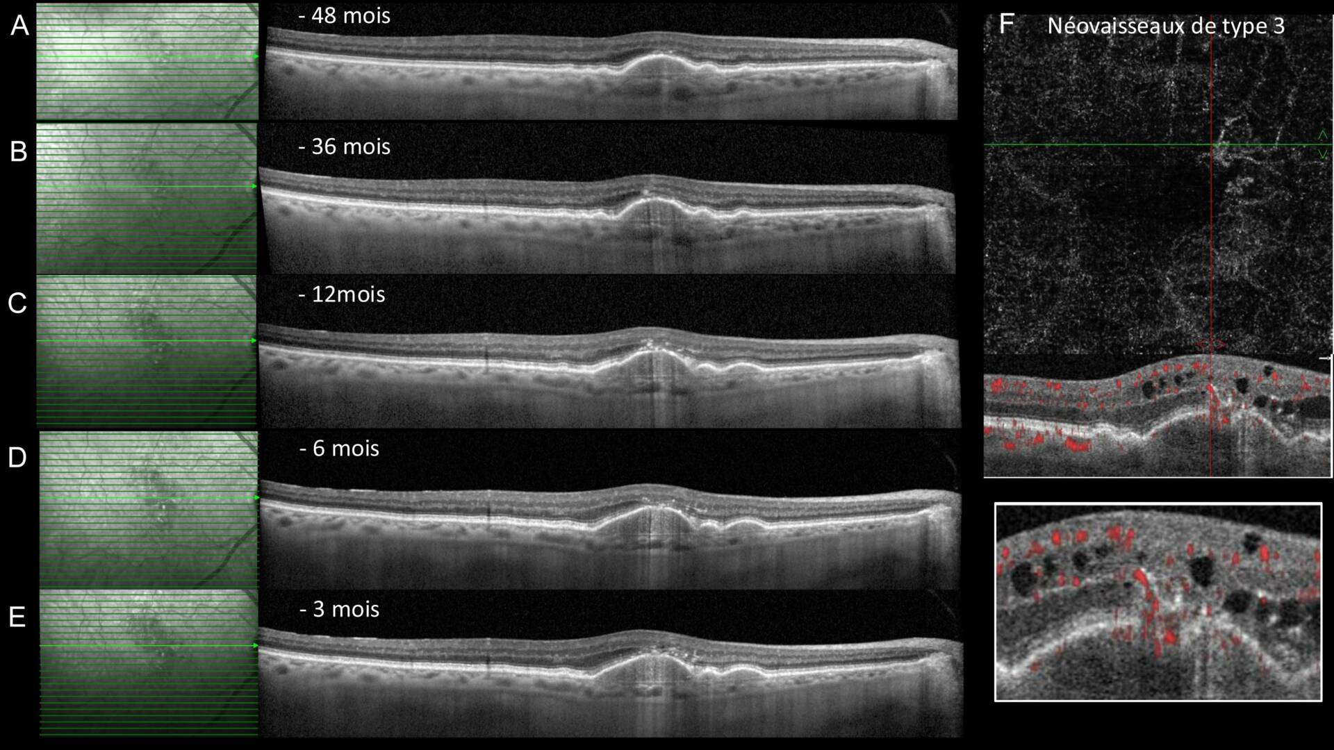 Figure 4. Exemple de DEP drusénoïde compliqué d’une néovascularisation maculaire de type 3. A-D : Les OCT successifs montrent une augmentation progressive de la hauteur et de la largeur du DEP drusénoïde, associée à l’apparition de points hyperréflectifs et à une interruption de la ligne de l’épithélium pigmentaire. E-F : Développement d’un néovaisseau maculaire de type 3 au niveau de l’apex du DEP drusénoïde, avec la présence de logettes intrarétiniennes et d’un signal de flux vertical en OCT-A.
