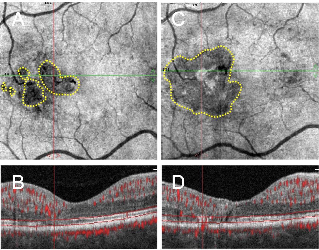 Figure 2. Majoration de la rupture de la zone ellipsoïde au bout de 4 années de suivi. A. Image en face de l’examen en OCT structurel segmenté au niveau des couches externes réalisé en 2017. Plusieurs ruptures de la zone ellipsoïde sont entourées en jaune. B. B-scan de l’OCT avec signal de flux. Le plexus capillaire profond prolifère en regard des ruptures de la zone ellipsoïde. C. En 2021, les ruptures ont conflué en une seule large rupture (entourée en jaune). D. La prolifération capillaire est piégée dans une migration pigmentaire.
