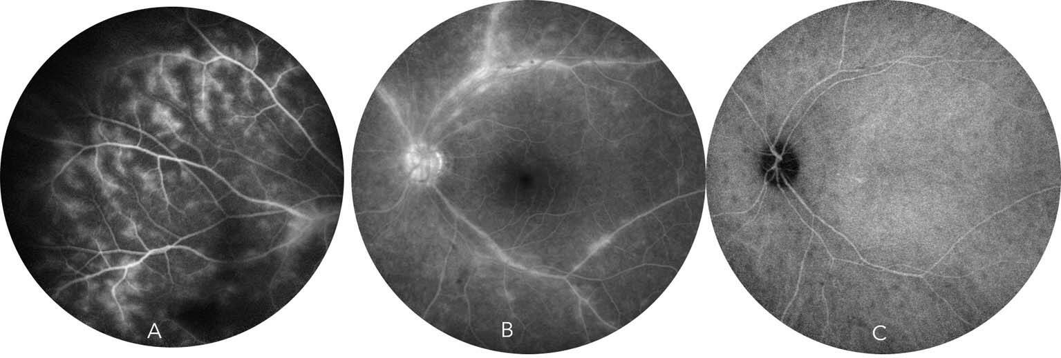 Figure 2. Rétinochoroïdopathie de type Birdshot. A et B. L’angiographie à la fluorescéine révèle une vascularite veineuse des gros troncs avec une diffusion papillaire, et une capillaropathie diffuse en feuilles de fougère. C. L’angiographie ICG montre de multiples granulomes choroïdiens prédominants en péripapillaire.
