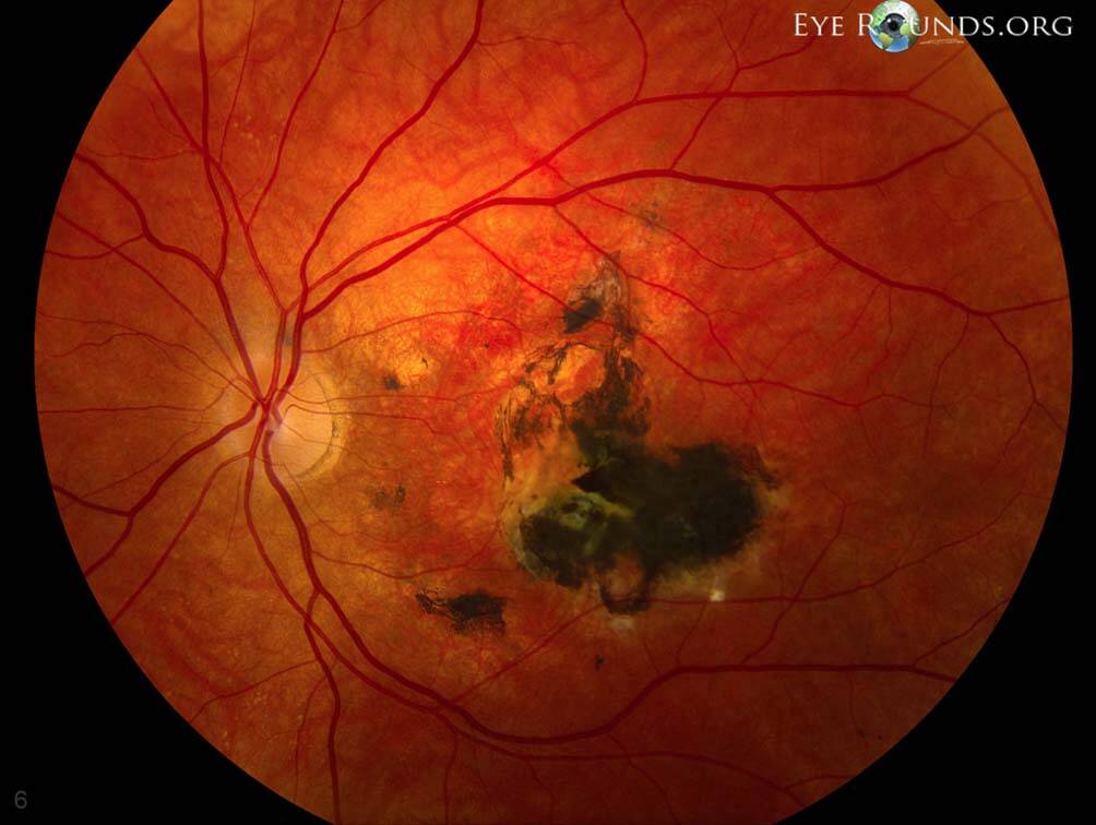 Figure 5. Dystrophie maculaire de Sorsby (© Dr Vislisel).
