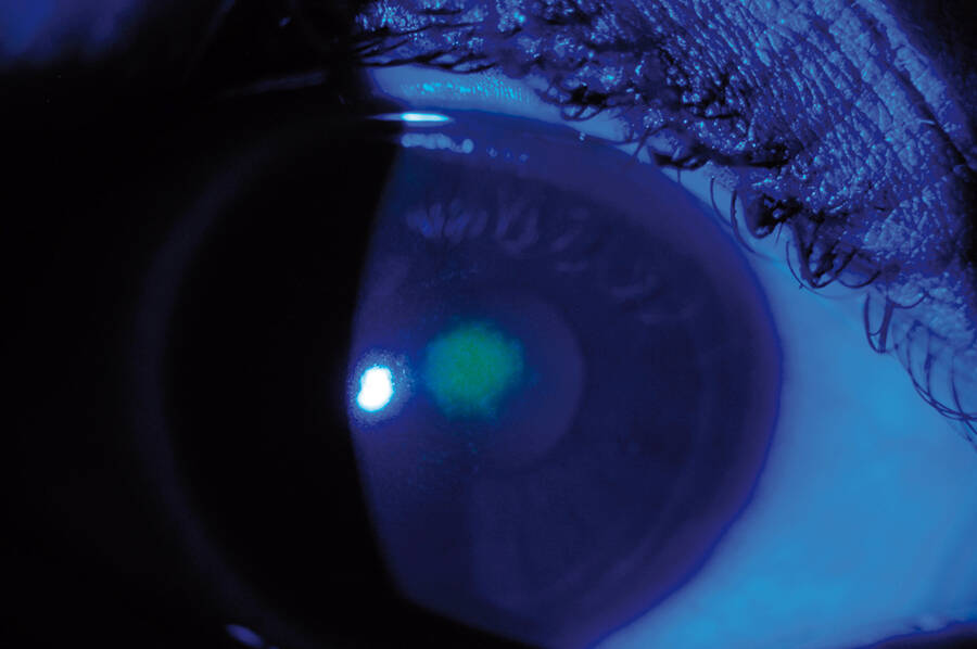 Figure 2. Kératite centrale prenant la fluorescéine, liée à un appui central de la lentille rigide trop plate par rapport à la géométrie cornéenne.
