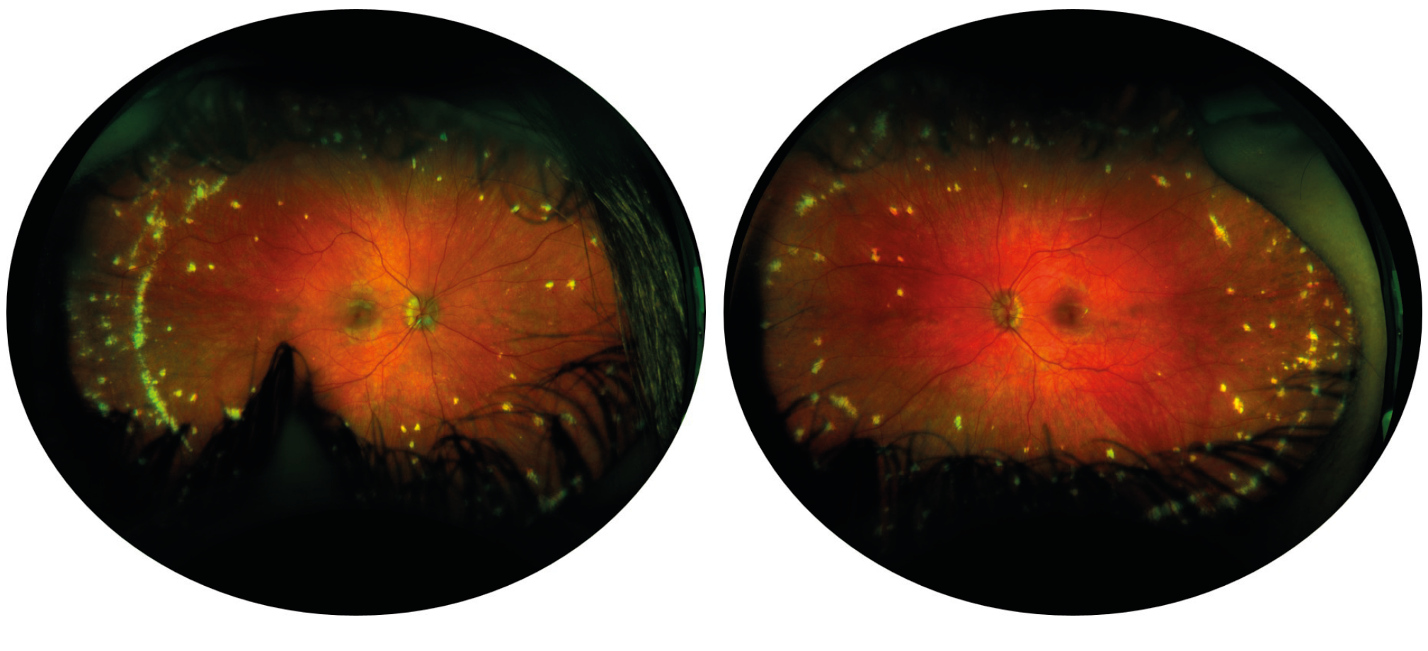 Figure 1. Enfant de 14 ans présentant une maladie de Vogt-Koyanagi-Harada. La rétinophotographie grand champ montre une dépigmentation bilatérale du fond d’œil et des nodules de Dalen-Fuchs en voie d’atrophie. La prise en charge a comporté de la cortisone orale en décroissance et un relais par mycophénolate mofétil associé à un traitement corticoïde local. 
