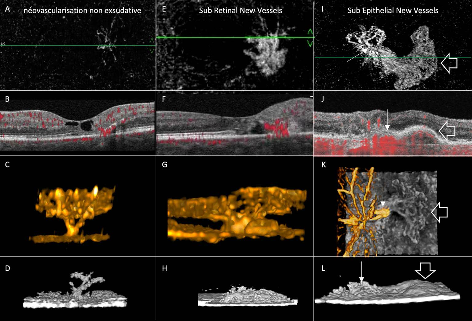 Figure 2. A, B, C et D. Néovascularisation non exsudative. C-scan (A) et B-scan (B) de l’examen en tomographie en cohérence optique angiographique (OCT-A) : prolifération vasculaire issue des télangiectasies du complexe capillaire profond (CCP) envahissant les couches externes dans la rupture de l’ellipsoïde. C. La reconstruction en 3D du signal de flux permet de visualiser les tractus néovasculaires. D. La reconstruction en 3D des hyperréflectivités permet de visualiser les migrations pigmentaires « moulant » les proliférations vasculaires. E, F, G et H. Néovascularisation sous-rétinienne. E. Le lassis néovasculaire est visible sur le C-scan. G. La reconstruction en 3D confirme la connexion entre celui-ci et les télangiectasies du CCP. H. Hyperréflectivité en dôme, irrégulière, du néovaisseau. I, J, K et L. Néovascularisation sous-épithéliale. I. On visualise la connexion entre le néovaisseau sous-rétinien et son extension sous l’épithélium pigmentaire. K. La reconstruction en 3D la met également bien en évidence. La reconstruction en 3D des hyperréflectivités permet de bien distinguer l’hyperréflectivité en dôme irrégulière du néovaisseau sous-rétinien, au-dessus de l’épithélium pigmentaire, et l’hyperréflectivité lisse de l’extension sous-épithéliale.

