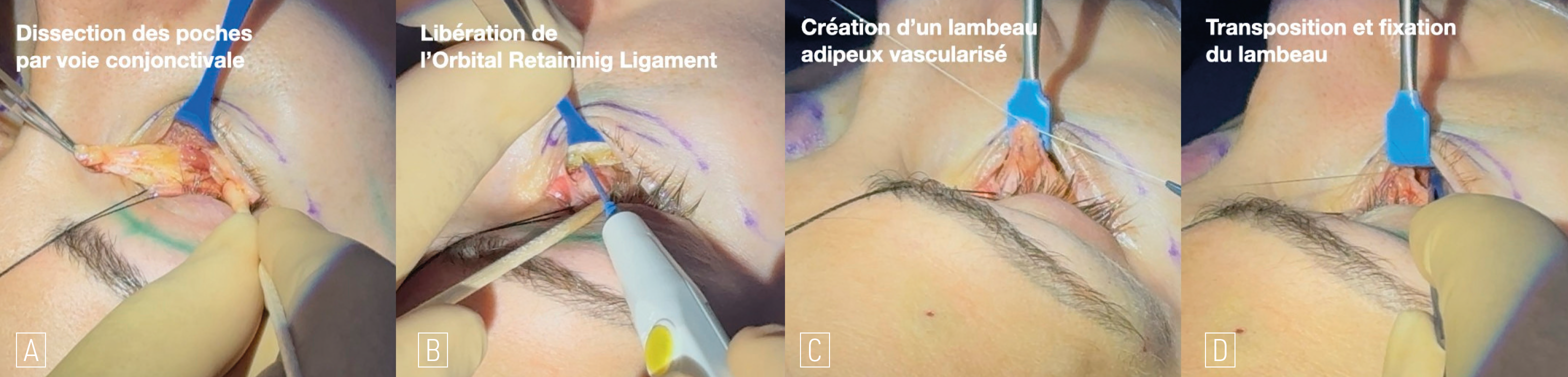 Figure 1. Étapes de la transposition par voie conjonctivale. A. Dissection des poches interne et centrale autour du muscle oblique inférieur. B. Libération de l’orbital retaining ligament à la pointe Colorado, au contact osseux. C. Création d’un lambeau adipeux vascularisé en suturant les poches interne et centrale. D. Transposition et étalement du lambeau le long du rebord orbitaire par 2 à 5 points de Vicryl 5/0 en le fixant aux tissus mous – muscle orbiculaire en interne, SOOF en externe.
