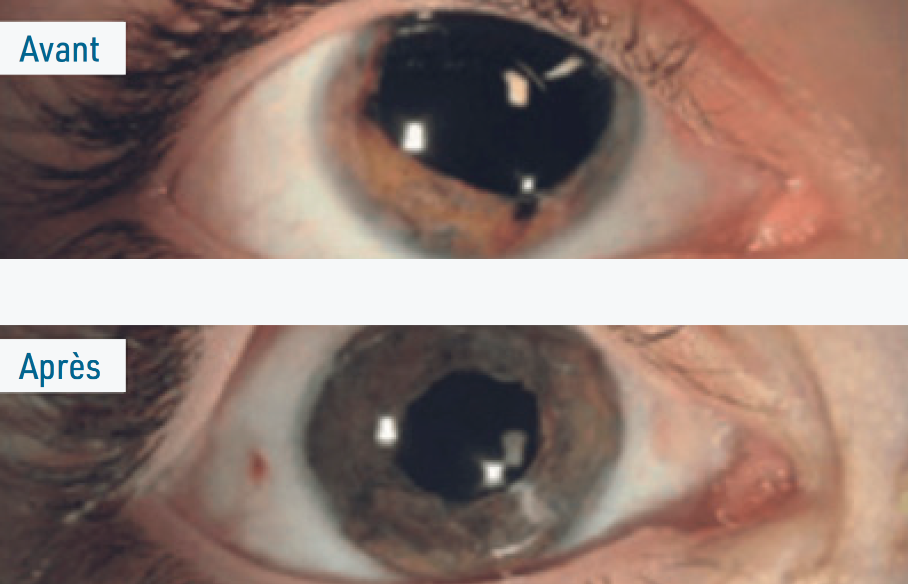 Figure 1. Kératopigmentation fonctionnelle (Laboratoires BIOTIC Phocea).
