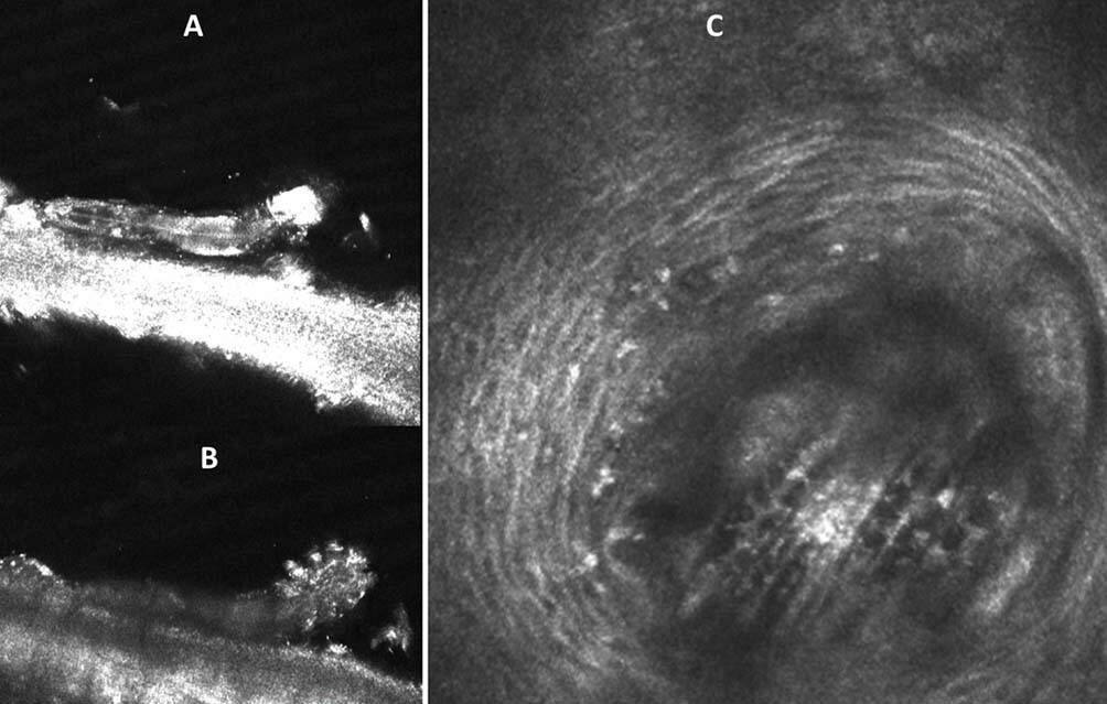 Figure 4. L’IVCM observe la présence de Demodex accrochés à un cil (A, B) et nichés à l’intérieur d’un follicule (C).
