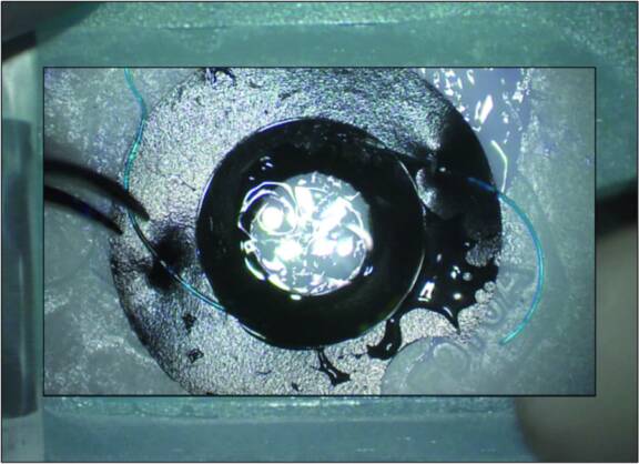 Figure 3. Préparation du bloc implant irien et réfractif avec encoche périphérique. L’implant est fixé grâce au passage des haptiques en PMMA par des encoches dans le silicone.
