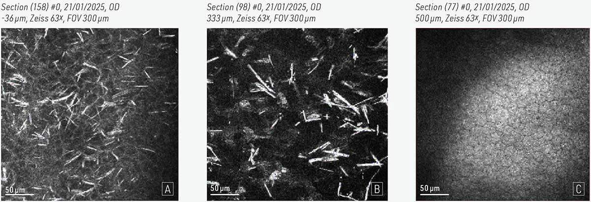Figure 3. Microscopie confocale in vivo (HRT-RCM®, Heidelberg Engineering, Heidelberg, Allemagne) : dépôts linéaires hyperréflectifs dans l’épithélium (A), le stroma moyen (B), l’endothélium sain (C). 
