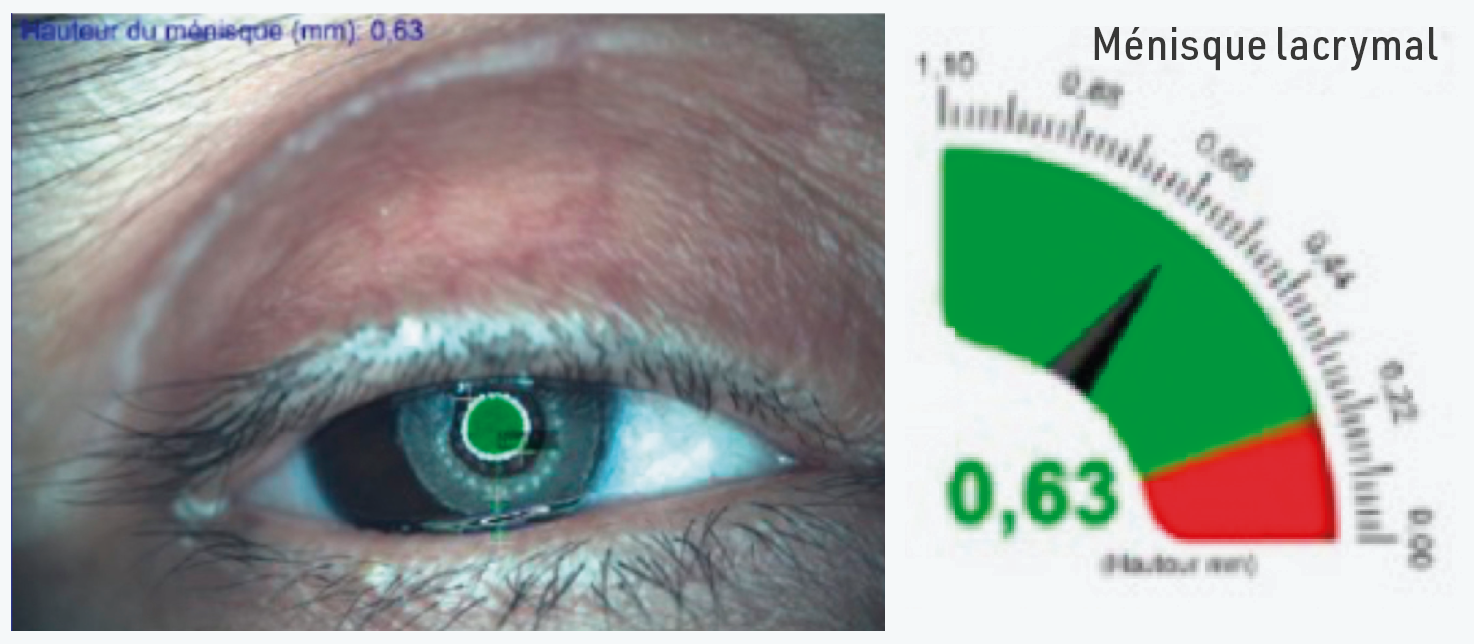 Figure 4 : Méniscométrie
