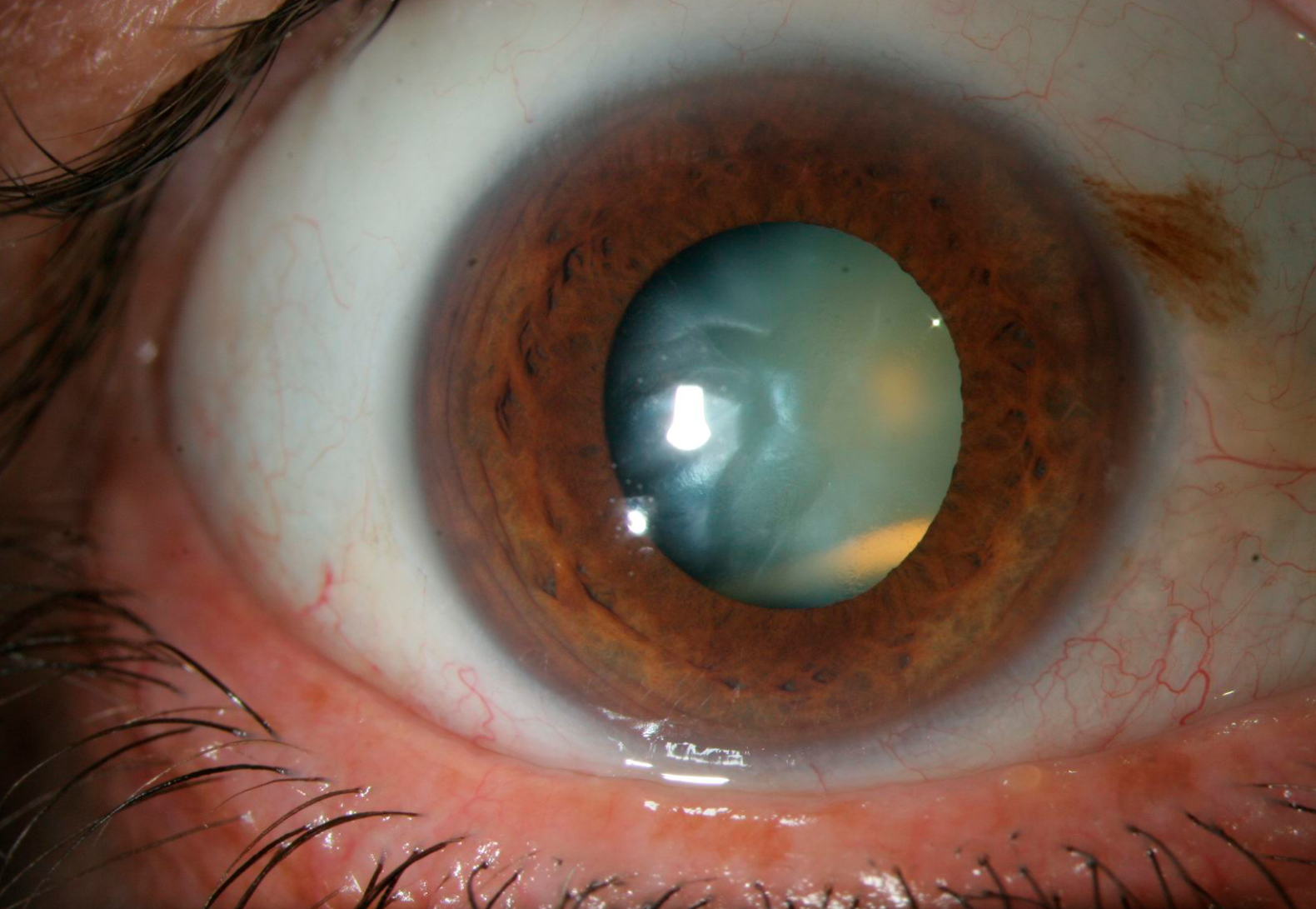 Figure 2. Placement accidentel en intracristallinien.
