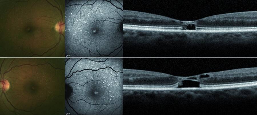 Figure 1. Maculopathie au tamoxifène : dépôts jaunâtres cristallins maculaires hyperautofluorescents en lumière bleue associés à des cavitations pseudo-kystiques rétrofovéales aux 2 yeux [1].
