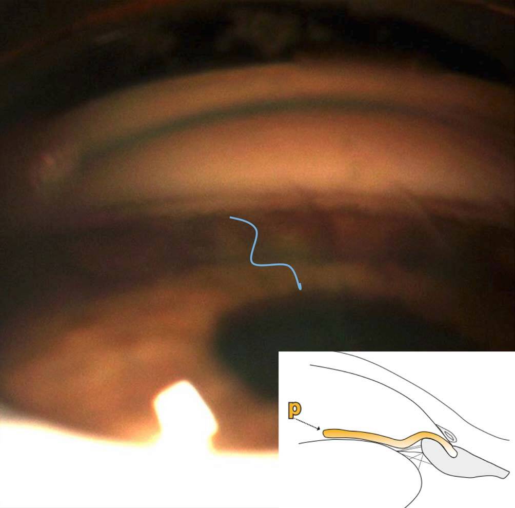 Figure 1. Au cours de l’examen gonioscopique avec indentation, nous observons l’aspect de l’iris en double bosse, typique d’un iris plateau.
