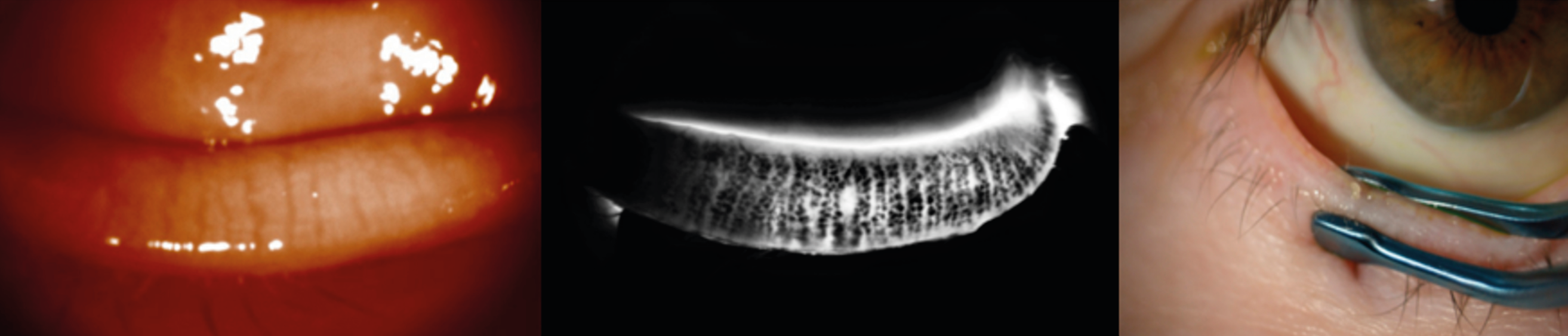 Figure 1. Équipements diagnostiques : la meibographie avec le Casia 2® (à gauche) et le C-Diag® (au milieu) et la meibo-expression. (source : Dr Marty). 
