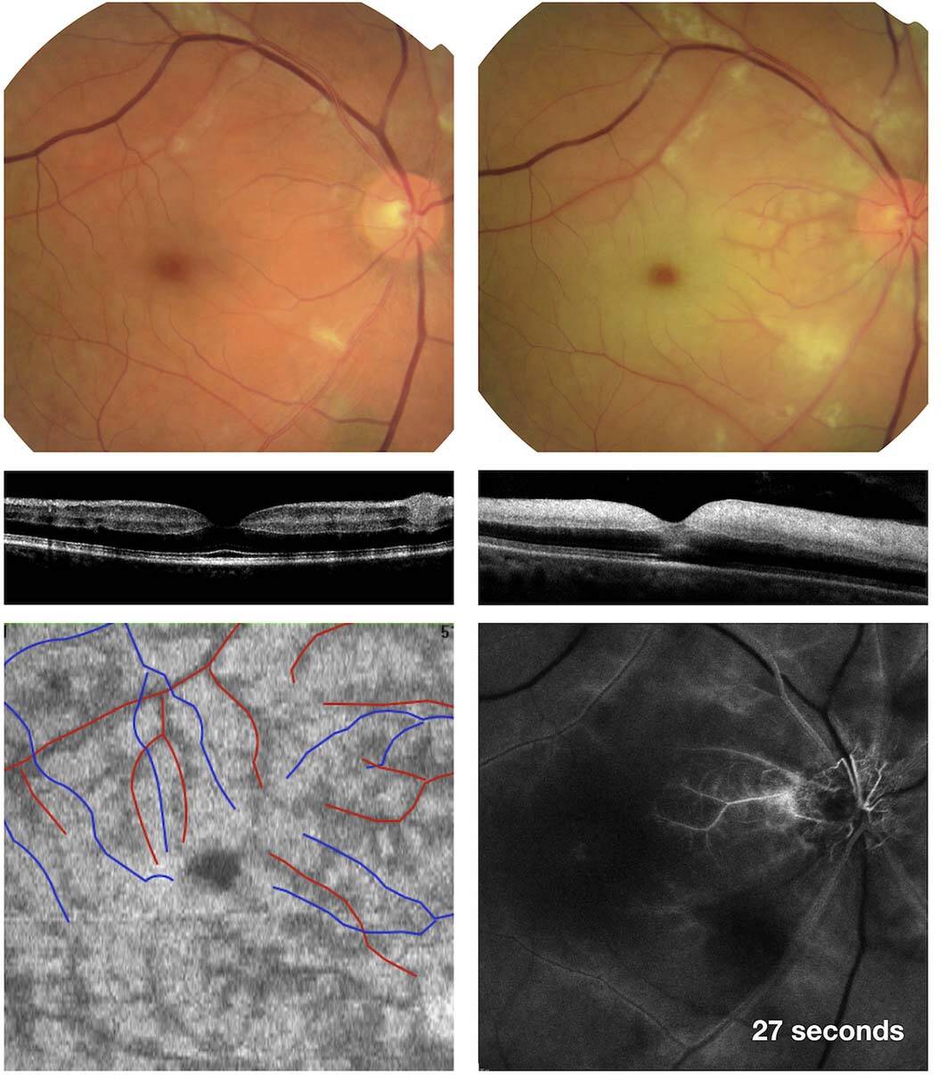 Figure 2. Exemple de cascade ischémique. Homme de 60 ans présentant une OACR incomplète avec lésions de PAMM prédomi nant en périveinulaire et qui, 5 jours plus tard, développe une OACR complète avec une hyperréflectivité de toute la rétine en OCT [7]. 
