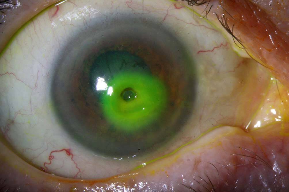 Figure 4. Kératolyse aseptique sur polyarthrite rhumatoïde : présence d’un descemetocèle ne fixant plus la fluorescéine (photothèque CHU de Lyon, Dr Romain Mouchel).
