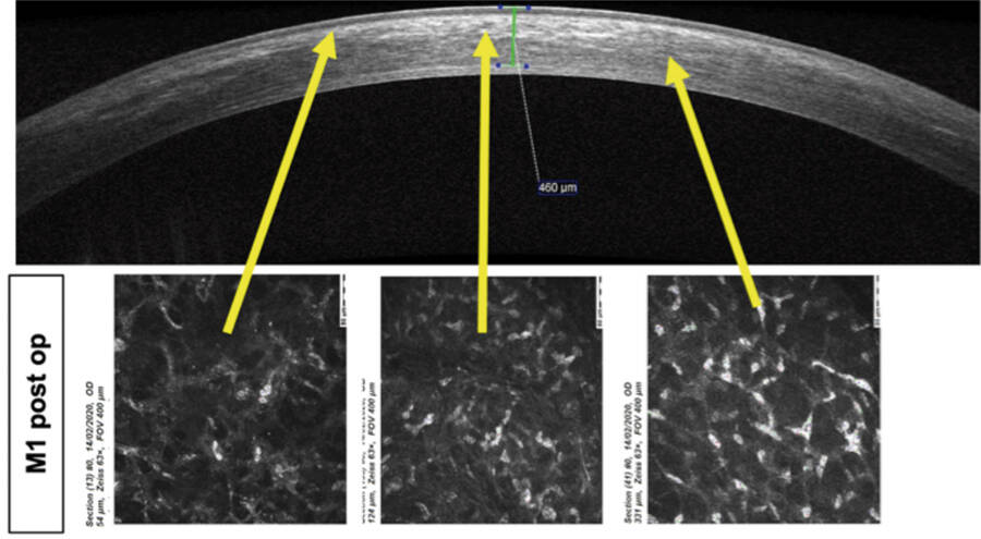 Figure. Imagerie OCT-SD d’une cornée cross-linkée avec un nouveau protocole de CXL transépithélial optimisé par l’hypersaturation en oxygène. La ligne de démarcation postérieure est bien visible à 1 mois postopératoire et l’imagerie correspondante en microscopie confocale confirme une apoptose kératocytaire dans la moitié antérieure de la cornée.
