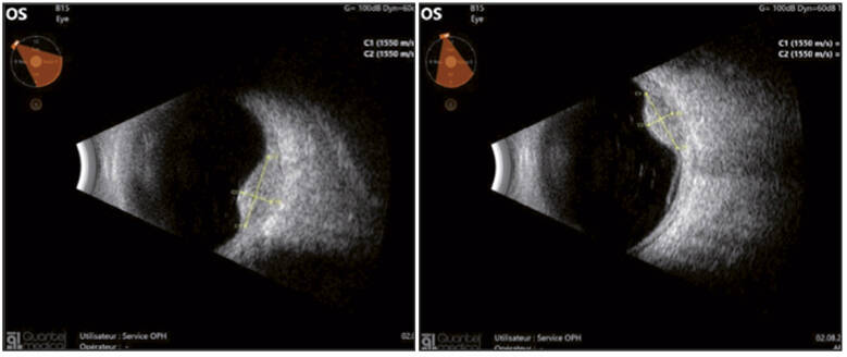 Figure 3. Échographie en mode B rapportant une volumineuse lésion choroïdienne (ABSolu – Quantel medical Lumibird – CHBA Vannes, service d’ophtalmologie).
