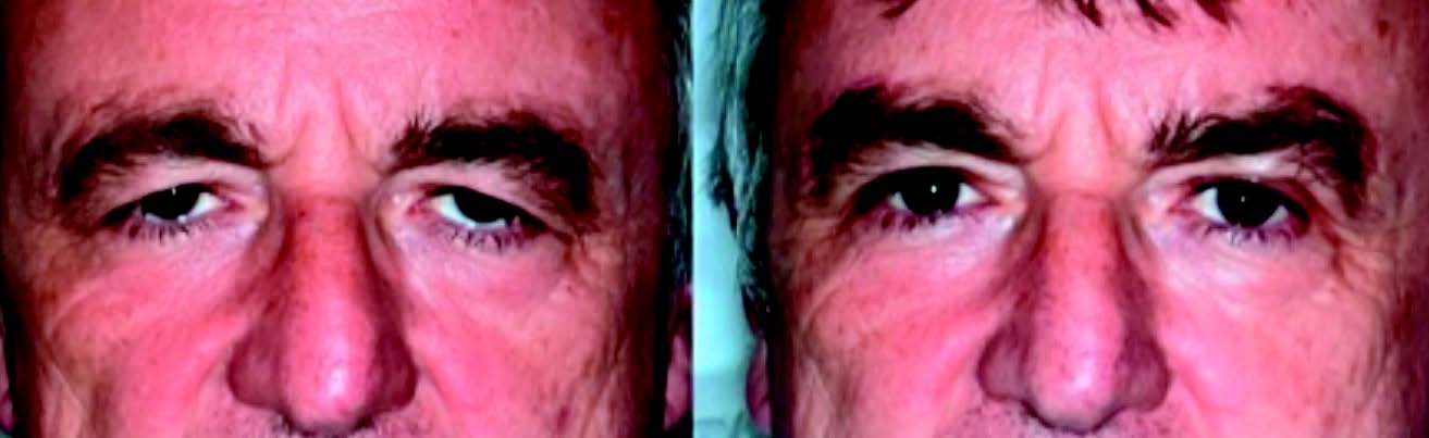 Figure 4. Résultat d’une blépharoplastie supérieure combinée à une correction du ptosis des sourcils par résection cutanée directe.
