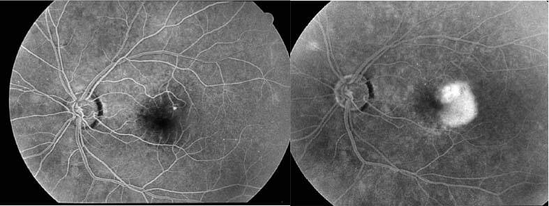 Figure 1. Aspect en angiographie à la fluorescéine d’une néovascularisation de type 3 au temps précoce (à gauche) et au temps tardif (à droite). On note la présence d’une hyperfluorescence précoce punctiforme au voisinage d’un vaisseau rétinien avec diffusion au temps tardif.
