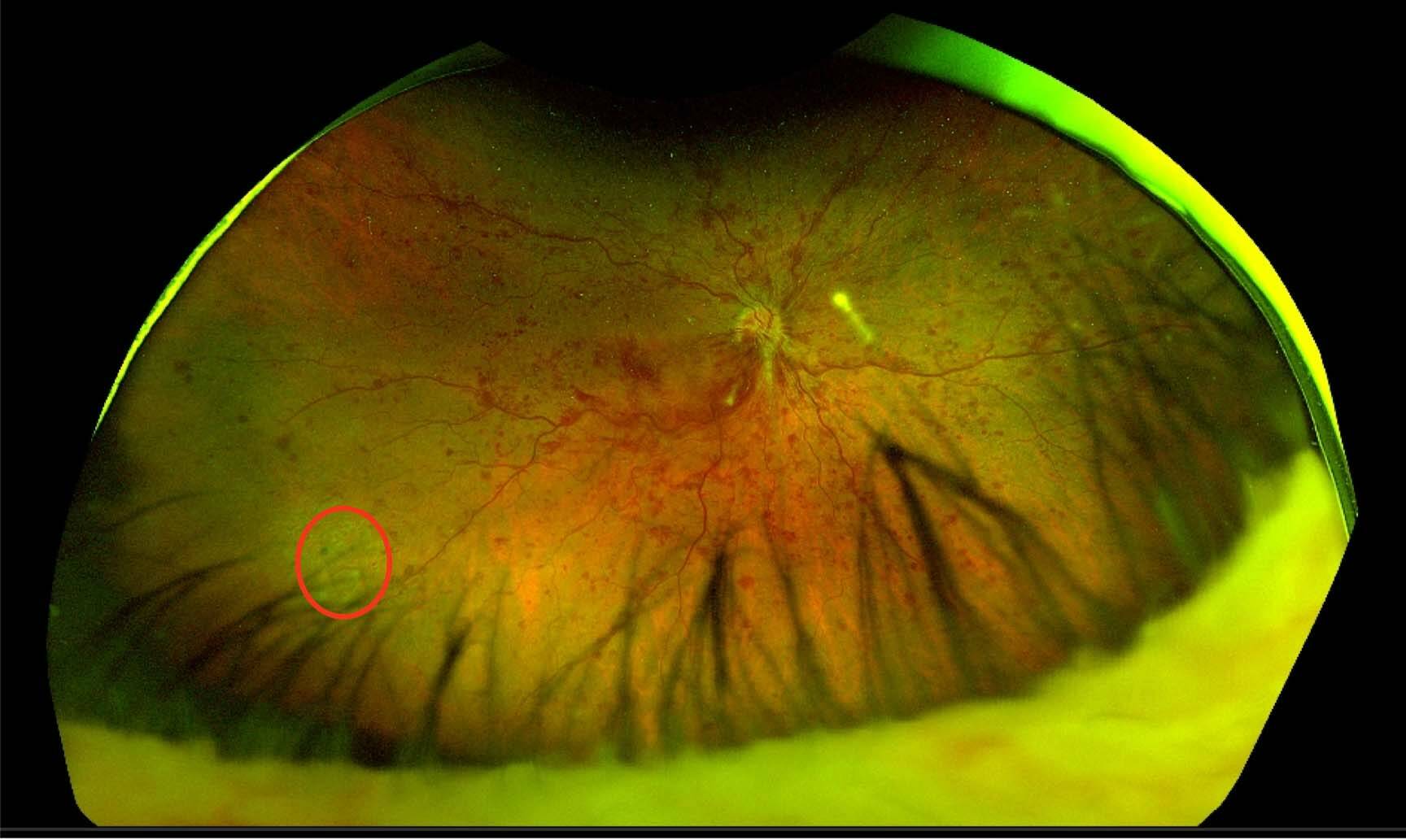 Figure 6. OVCR symptomatique et déchirure rétinienne de découverte fortuite.
