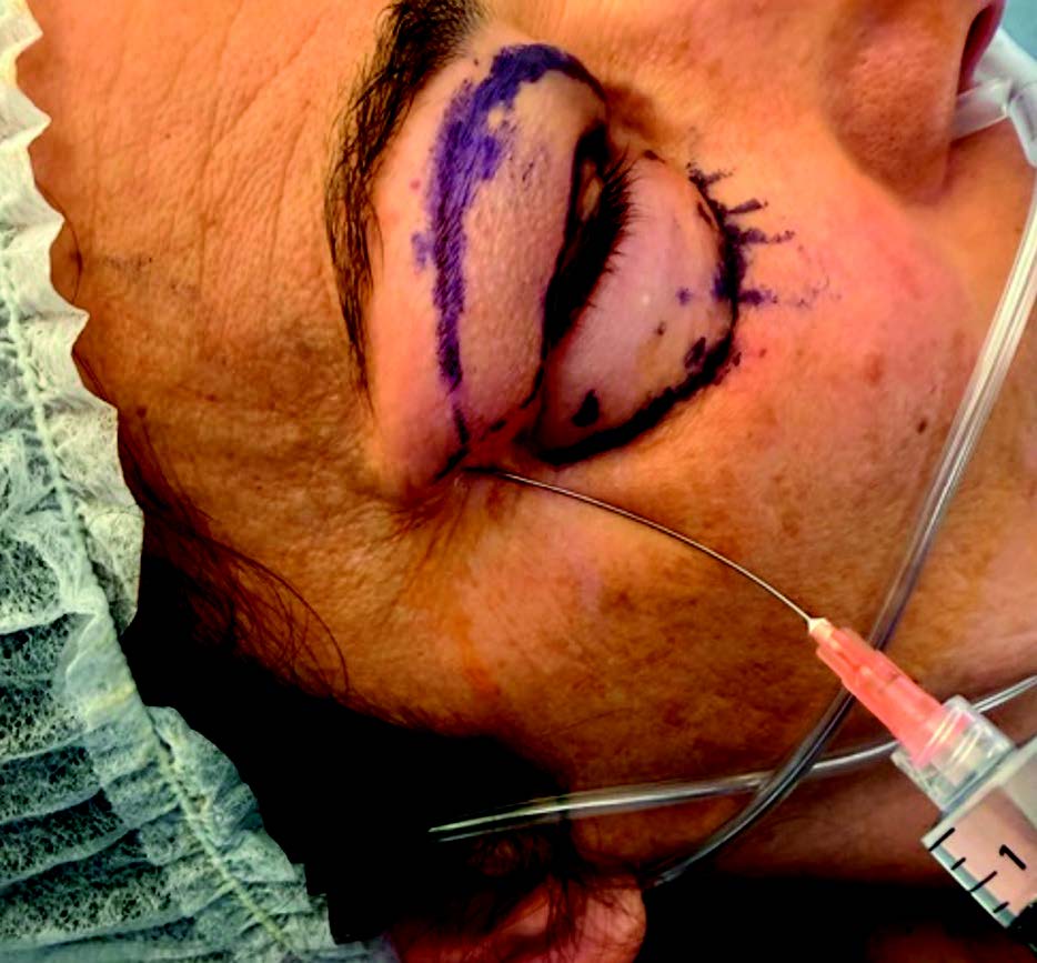 Figure 8. Bloc zygomatico-temporal.
