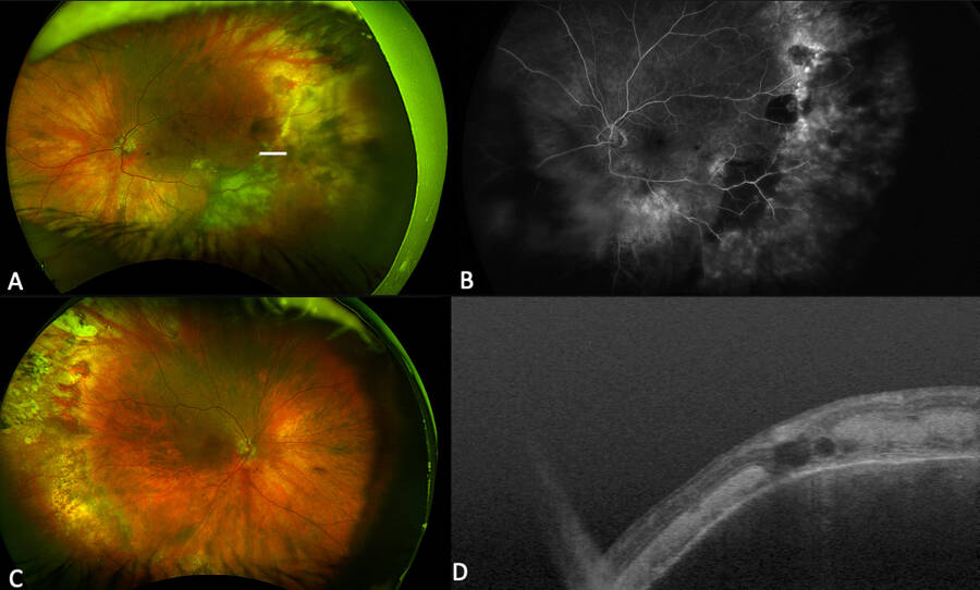 Figure 6. A. Photo grand champ du fond d’œil montrant des remaniements hémorragiques périphériques d’âges différents. B. Angiographie à la fluorescéine montrant un effet masque des hémorragies et de la fibrose, et une diffusion le long d’une frange de fibrose sous-rétinienne. C. Photo grand champ du fond d’œil controlatéral montrant des cicatrices d’hématomes et des remaniements périphériques. D. Coupe OCT passant dans la zone remaniée (coupe sur A) montrant un mélange de fibrose et de sang en intrarétinien associé à un œdème rétinien. 
