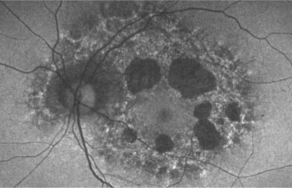 Figure 1. SAD ponctiformes et plages d’atrophie paracentrales situées à distance du point de fixation dans un MIDD.
