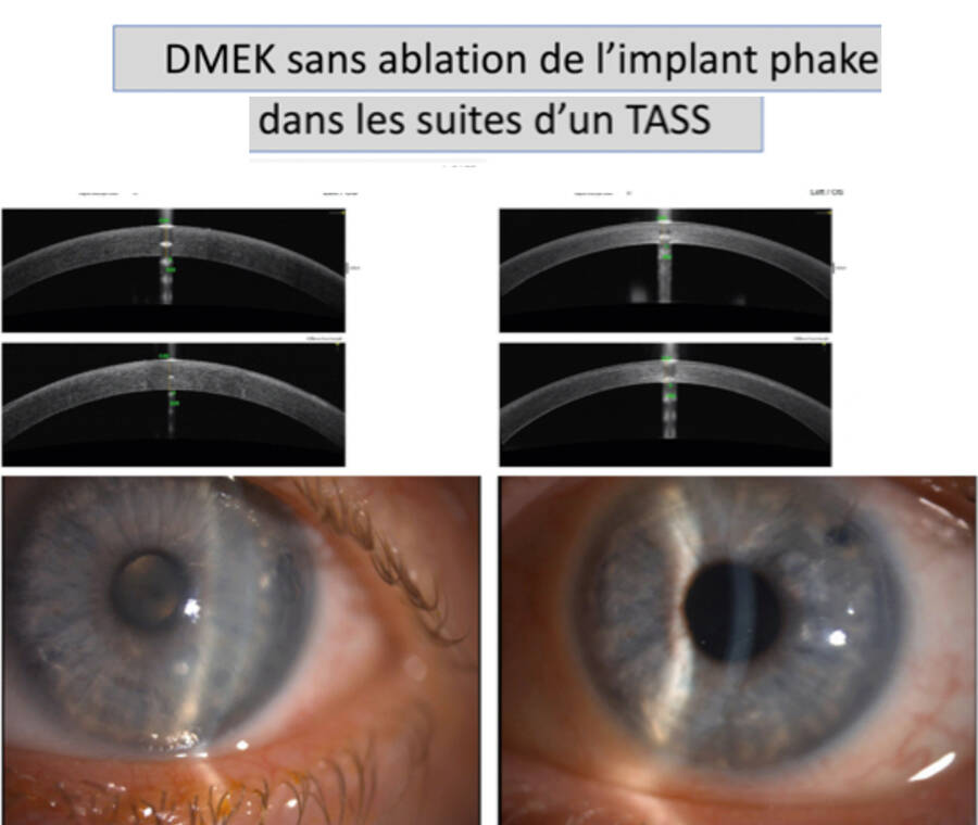 Figure 2. À gauche. Avant DMEK, TASS survenu après l’implantation d’un implant phake chez une jeune myope de -20 D. À droite. Après DMEK sans ablation de l’implant phake.
