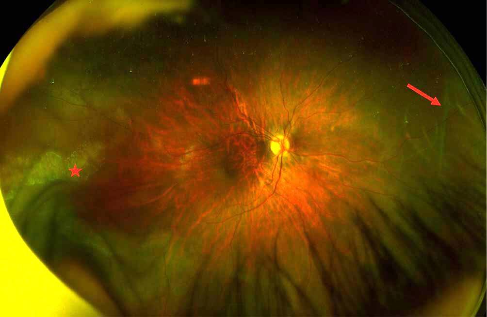 Figure 2. Enfant de 3 ans présentant un syndrome de Stickler de type 2.
