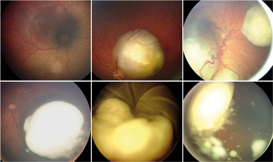 Figure 1. Rétinoblastome à différents stades, au diagnostic.
