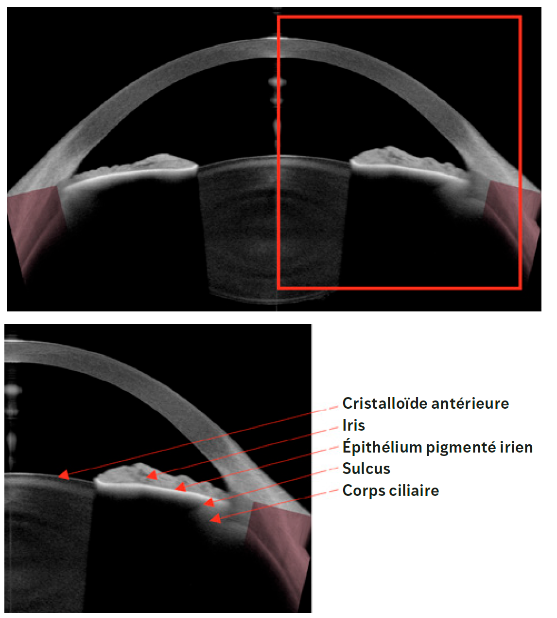 Figure 1. repères anatomiques de la chambre postérieure visualisés par AS-OCT.
