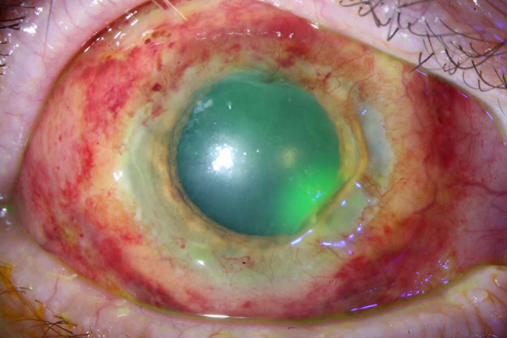 Figure 2. Ulcère de pseudo-Mooren ayant permis de diagnostiquer une vascularite de type granulomatose avec polyangéite (ex-Wegener). Aspect à M+3 après mise en route d’un traitement par rituximab (photothèque CHU de Lyon, courtesy of Dr Christelle Gilli).
