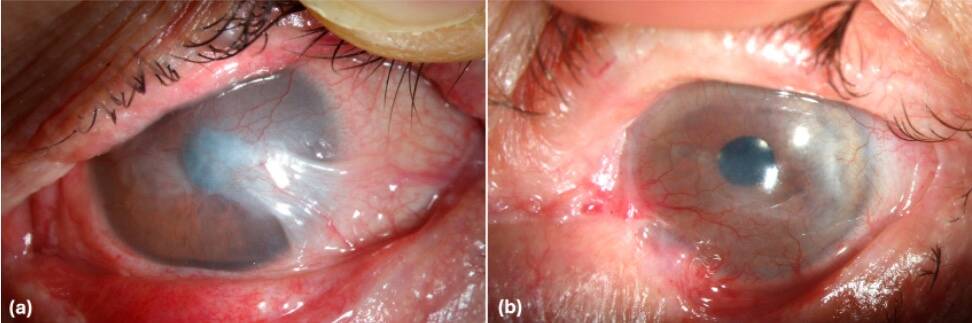 Figure 2. Ptérygoïdes associées à un syndrome de Lyell (a) et à une pemphigoïde des muqueuses (b).
