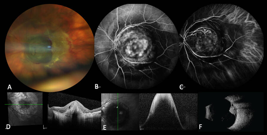 Figure 5. A. Rétinophotographie couleur montrant la lésion pigmentée maculaire. B. Angiographie à la fluorescéine montrant une diffusion hétérogène dans la lésion sans « pin points » et un effet masque autour. C. Angiographie à la fluorescéine montrant la présence de vaisseaux au centre et un effet masque autour. D. Coupe OCT maculaire datant de 3 ans avant l’apparition de la masse : remaniements pigmentaires, atrophie et fibrose sous-rétinienne avec exsudation rétinienne. E. Coupe OCT passant par la lésion. F. Échographie B montrant une lésion hétérogène plutôt hyperéchogène avec des lacunes et des calcifications.
